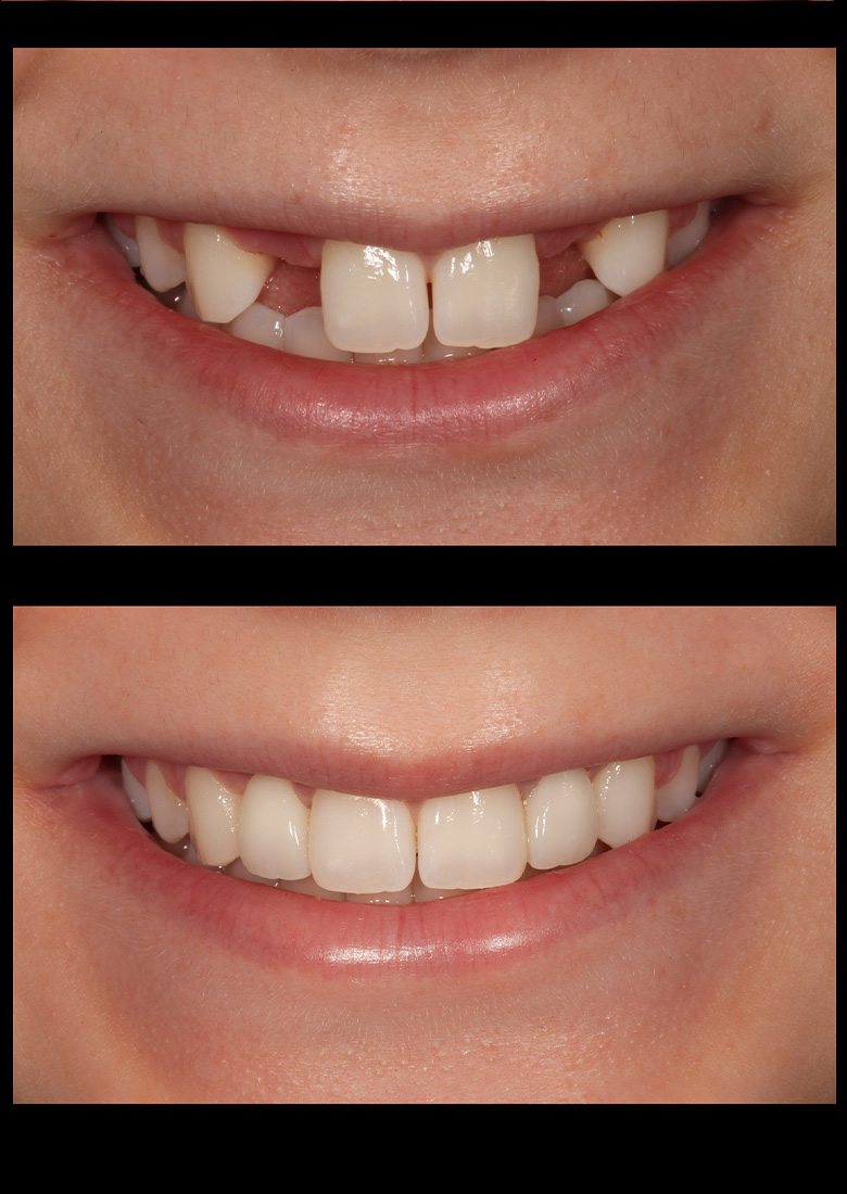 Bellevue Wa Cosmetic Smile Gallery