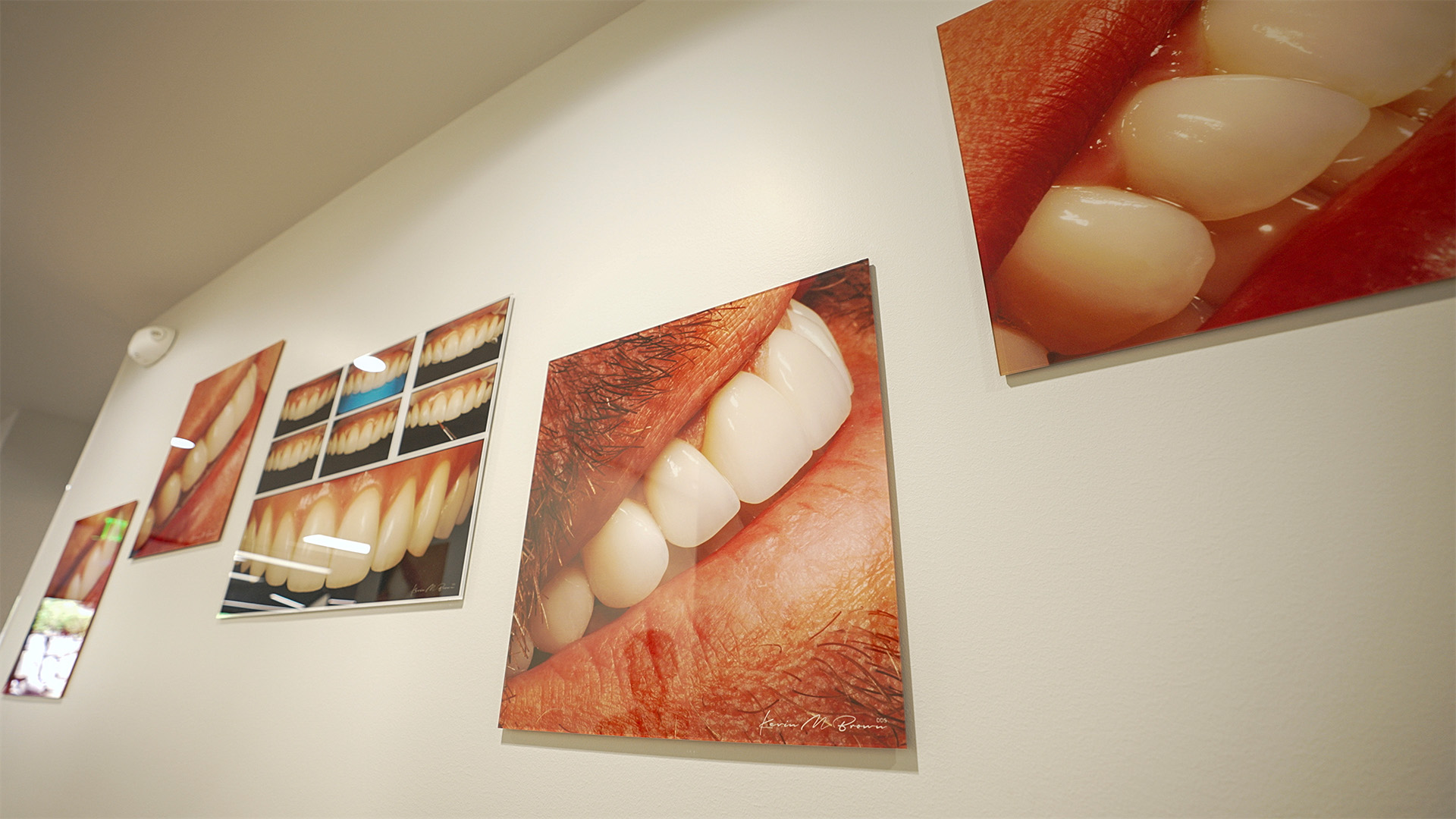 Dentists Bellevue Washington Minimally Invasive Dental Aesthetics