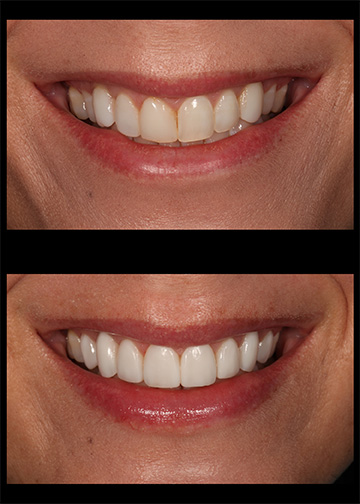 Bellevue Wa Dentist Composite Veneers