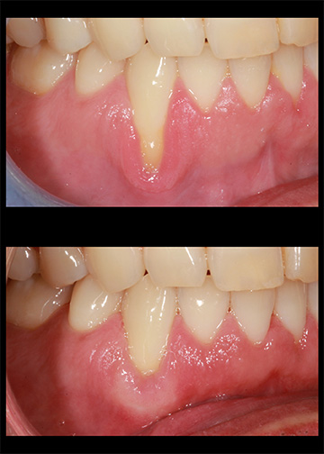 Bellevue Wa Dentists Pinhole Gum Rejuvenation