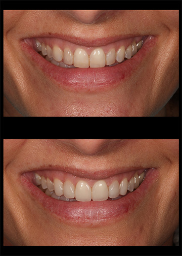 Bellevue Washington Dentist Composite Veneers