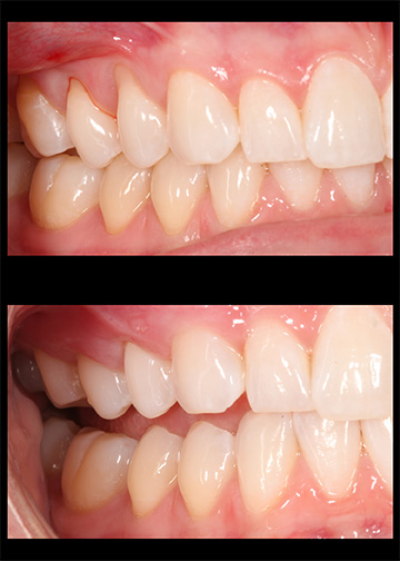 Bellevue Washington Dentist Pinhole Gum Rejuvenation