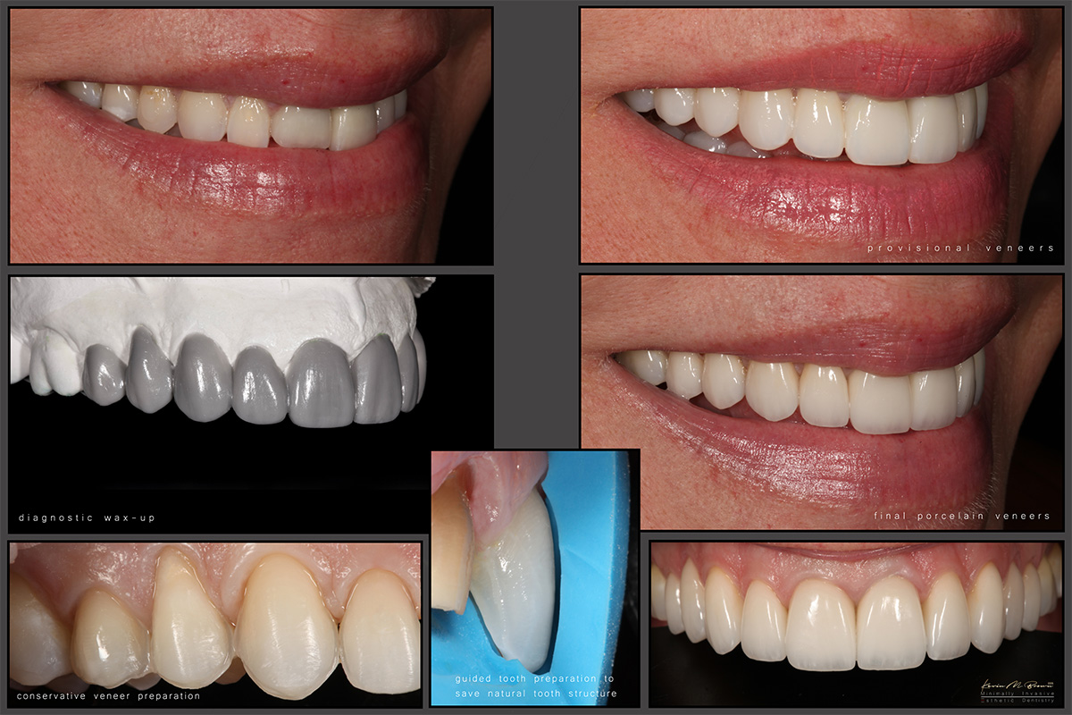 Bellevue Washington Dentist Porcelain Veneers