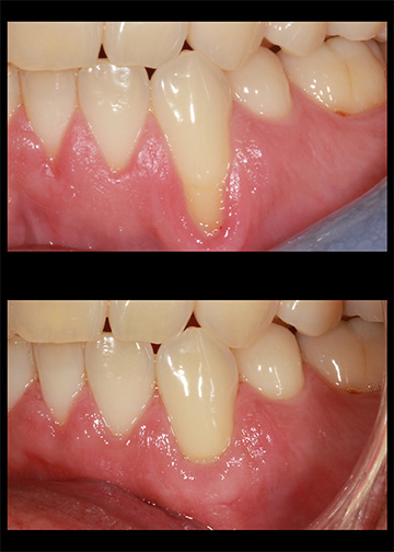 Bellevue Washington Dentists Pinhole Gum Rejuvenation