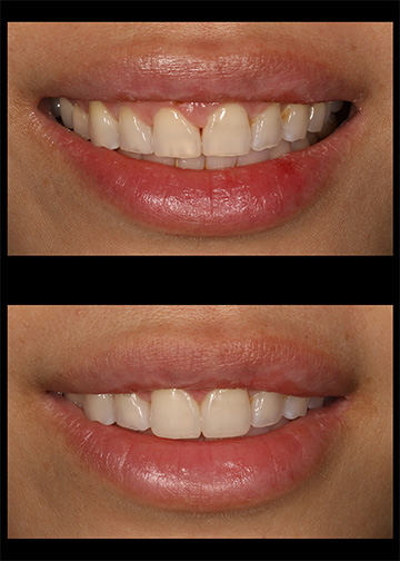 Bellevue Washington Dentists Smile Gallery Gaps