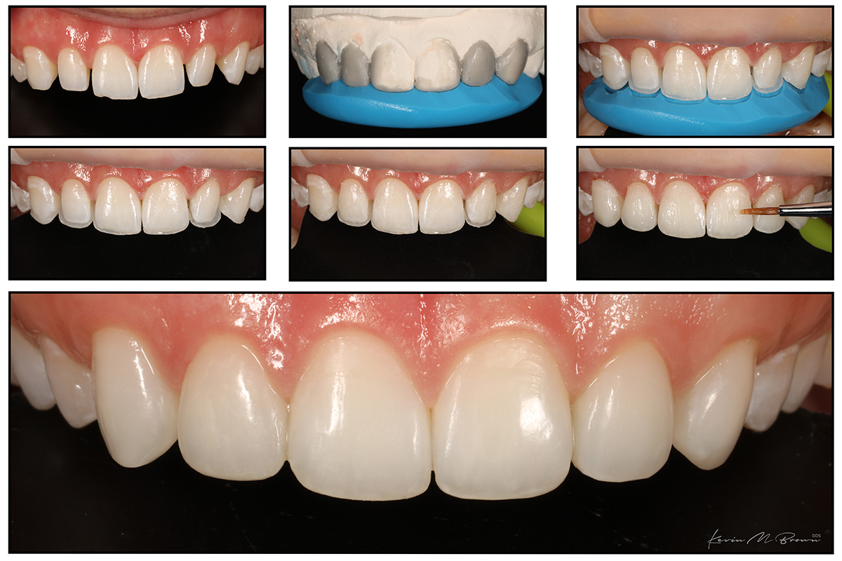 Composite Veneers Bellevue Wa Dentist