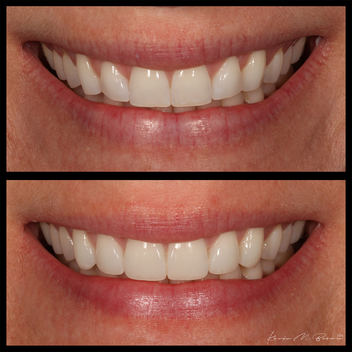 Composite Veneers Cosmetic Dentists Bellevue, Wa