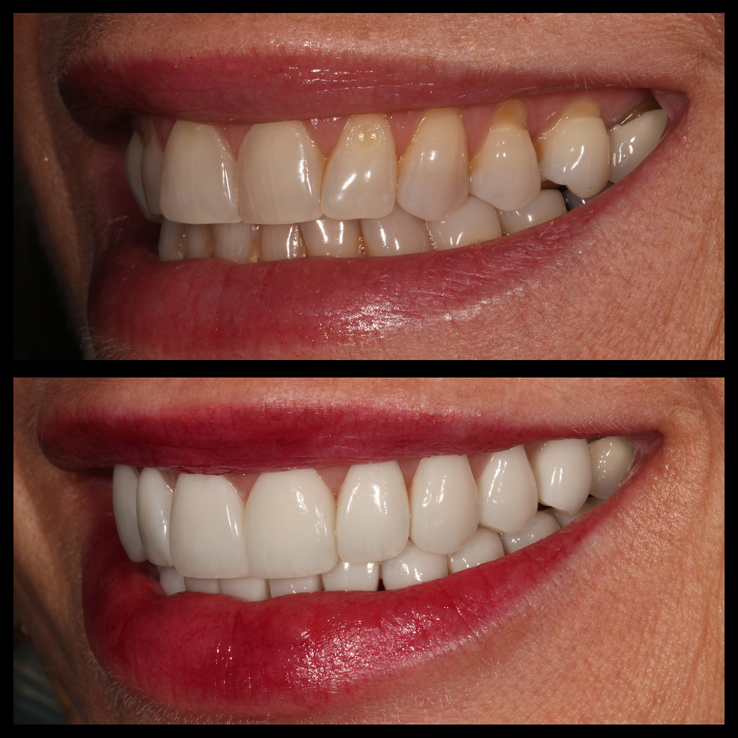 Composite Veneers Cosmetic Dentists In Bellevue, Wa