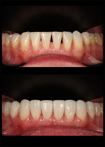 Composite Veneers Smile Gallery Cosmetic Dentists In Bellevue, Wa