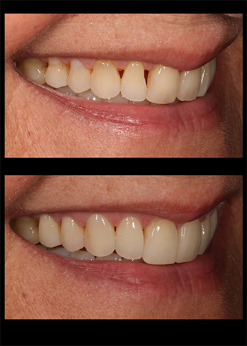 Cosmetic Dentists In Bellevue Wa Gaps