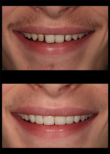 Dentist Bellevue Wa Composite Veneers