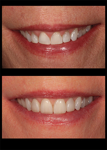 Dentist Bellevue Washington Composite Veneers