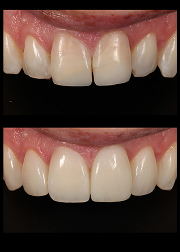 Dentist Composite Veneers