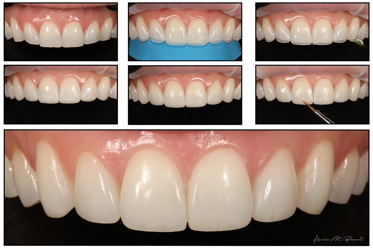 Dentist Greater Seattle Area Composite Veneers