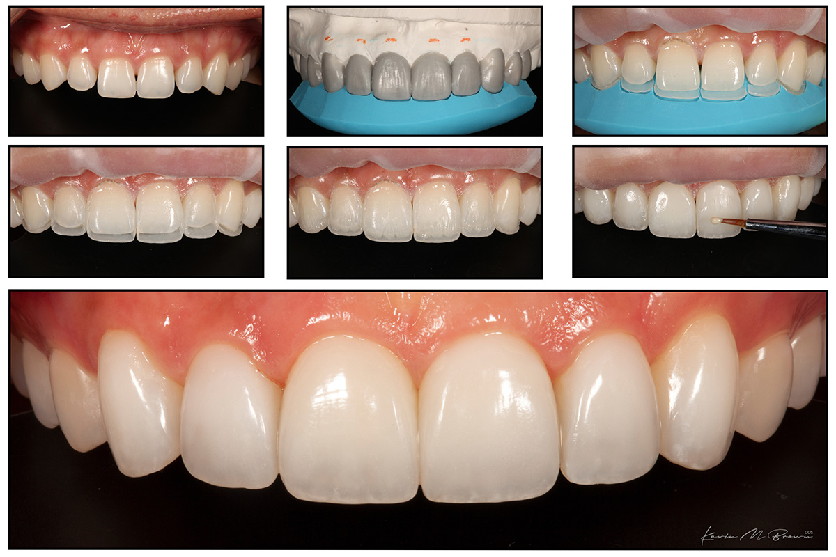 Dentist Seattle Greater Area Composite Veneers