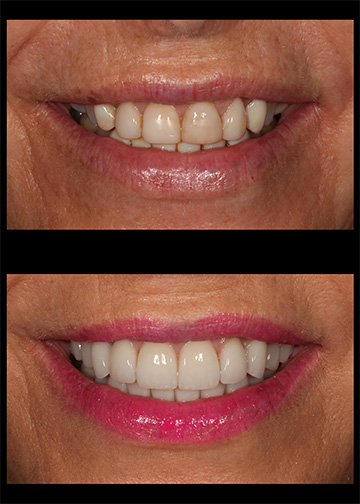 Dentist In Bellevue Wa Composite Veneers