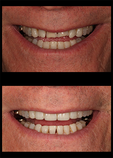 Dentists Composite Veneers