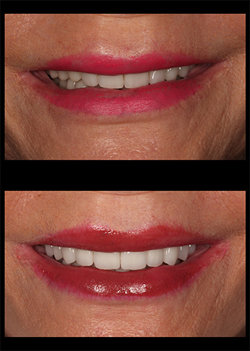 Full Mouth Rejuvenation Bellevue Wa