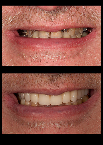 Full Mouth Rejuvenation Gallery Bellevue Wa Dentists