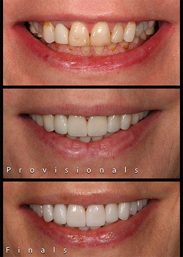 Full Mouth Rejuvenation Smile Gallery Bellevue Wa