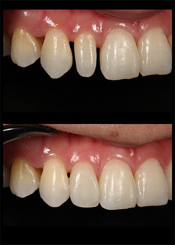 Narrow Teeth Gallery Cosmetic Dentists Bellevue Wa