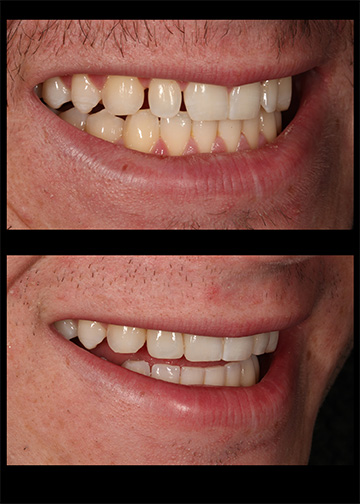 Narrow Teeth Smile Gallery Cosmetic Dentists In Bellevue Wa