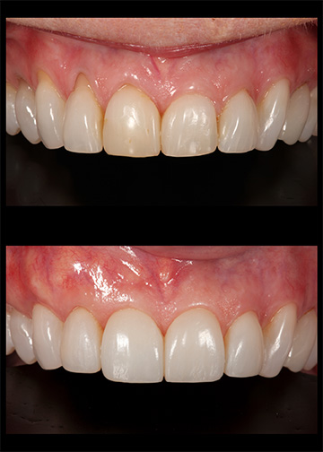 Pinhole Gum Rejuvenation Smile Gallery Bellevue Wa Dentists