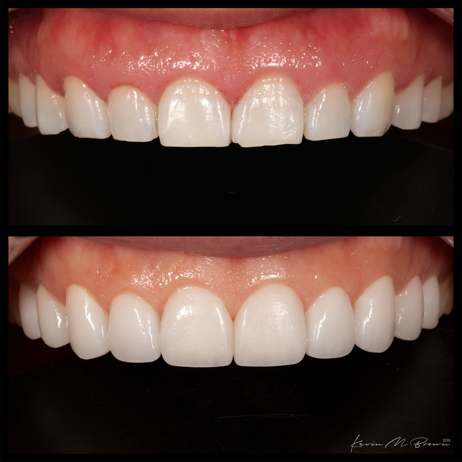 Porcelain Veneers Cosmetic Dentists Bellevue Wa