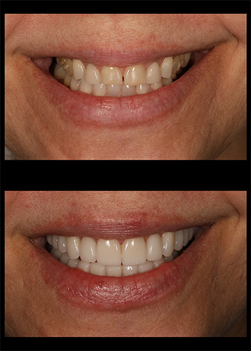 Porcelain Veneers Cosmetic Dentists Bellevue Washington