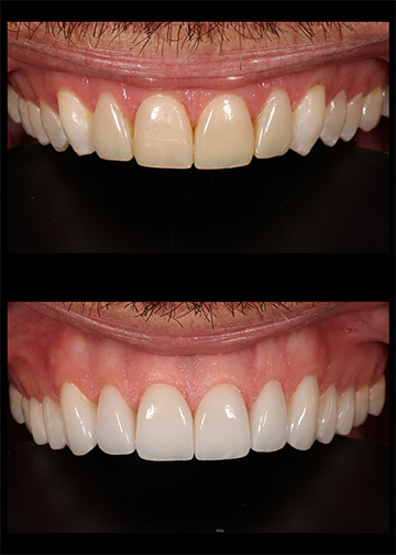 Porcelain Veneers Dentists In Bellevue Wa