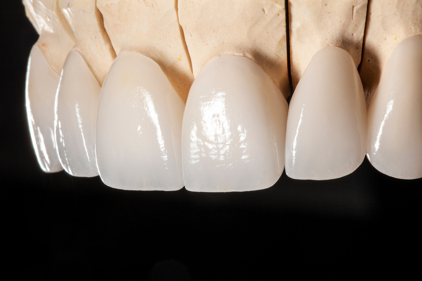 Porcelain Veneers Dentists In Greater Seattle