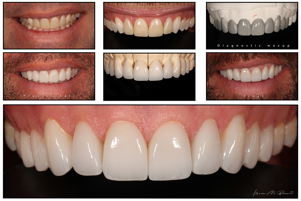 Porcelain Veneers Gallery Cosmetic Dentists Bellevue Wa