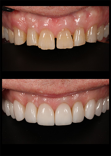 Porcelain Veneers Gallery Cosmetic Dentists Wa