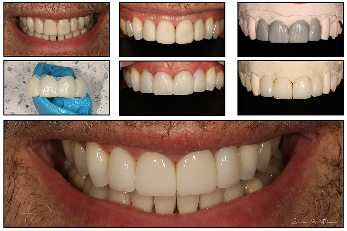 Porcelain Veneers Gallery Cosmetic Dentists In Bellevue Wa