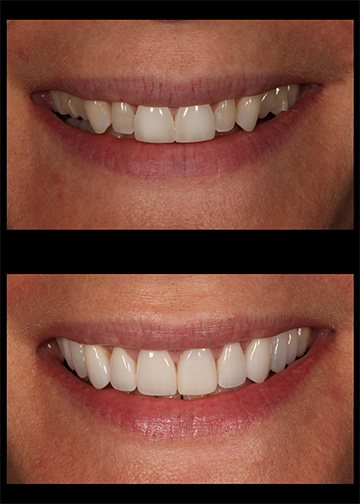 Porcelain Veneers Smile Cosmetic Dentists In Bellevue Washington