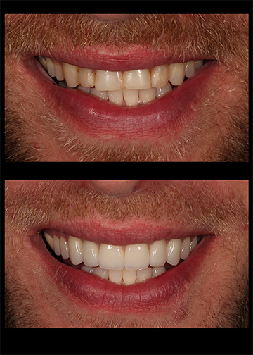 Porcelain Veneers Smile Gallery Cosmetic Dentists Wa