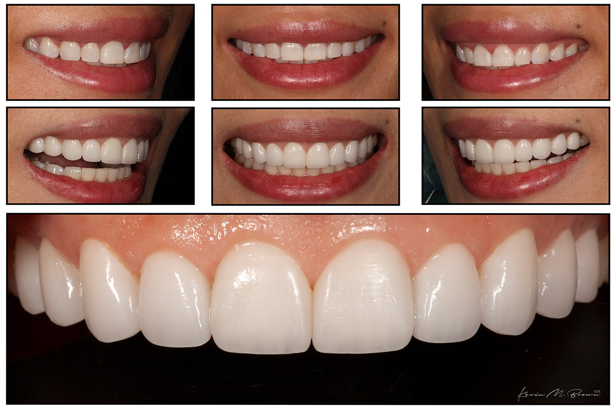 Porcelain Veneers Smile Gallery Cosmetic Dentists In Bellevue Wa