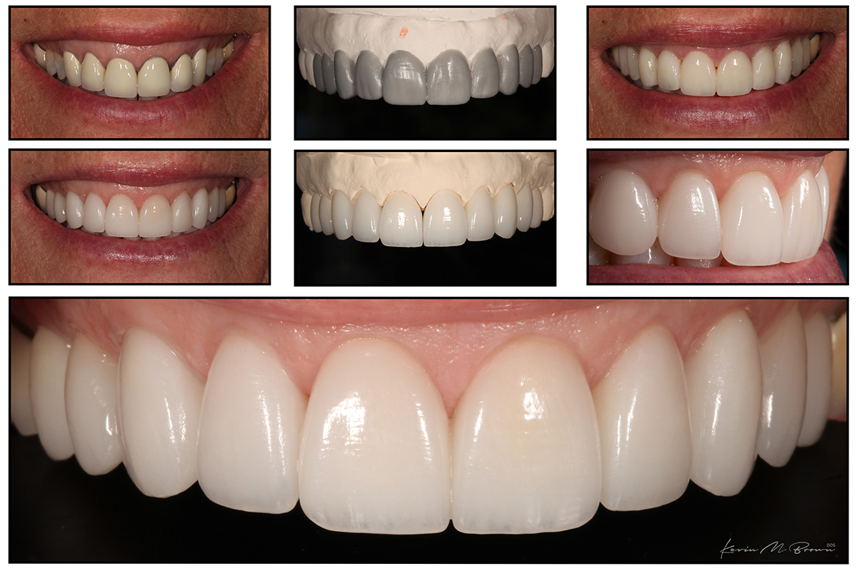 Porcelain Veneers Smile Gallery Cosmetic Dentists In Bellevue Washington