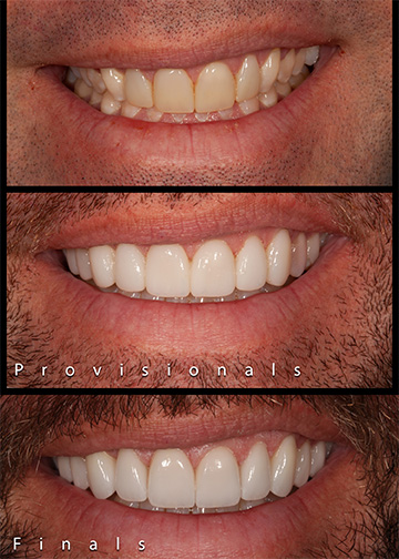 Porcelain Veneers Smile Gallery Cosmetic Dentists