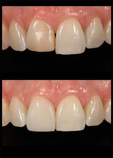 Replacements Revisions Gallery Bellevue Wa Dentists