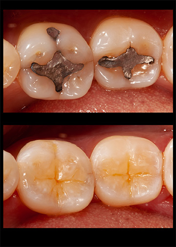 Replacements Revisions Smile Gallery Bellevue Wa Dentists