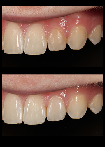 Replacements Revisions Smile Gallery Bellevue Wa