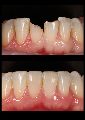 Worn Chipped Teeth Bellevue Wa