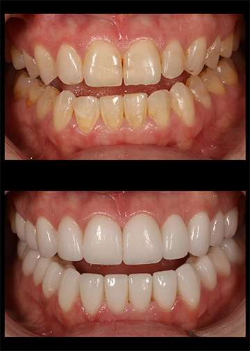 Porcelain Veneers Dentists In Bellevue Wa
