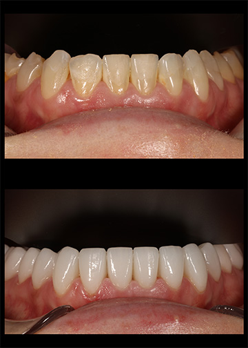 Porcelain Veneers Dentists In Bellevue Washington