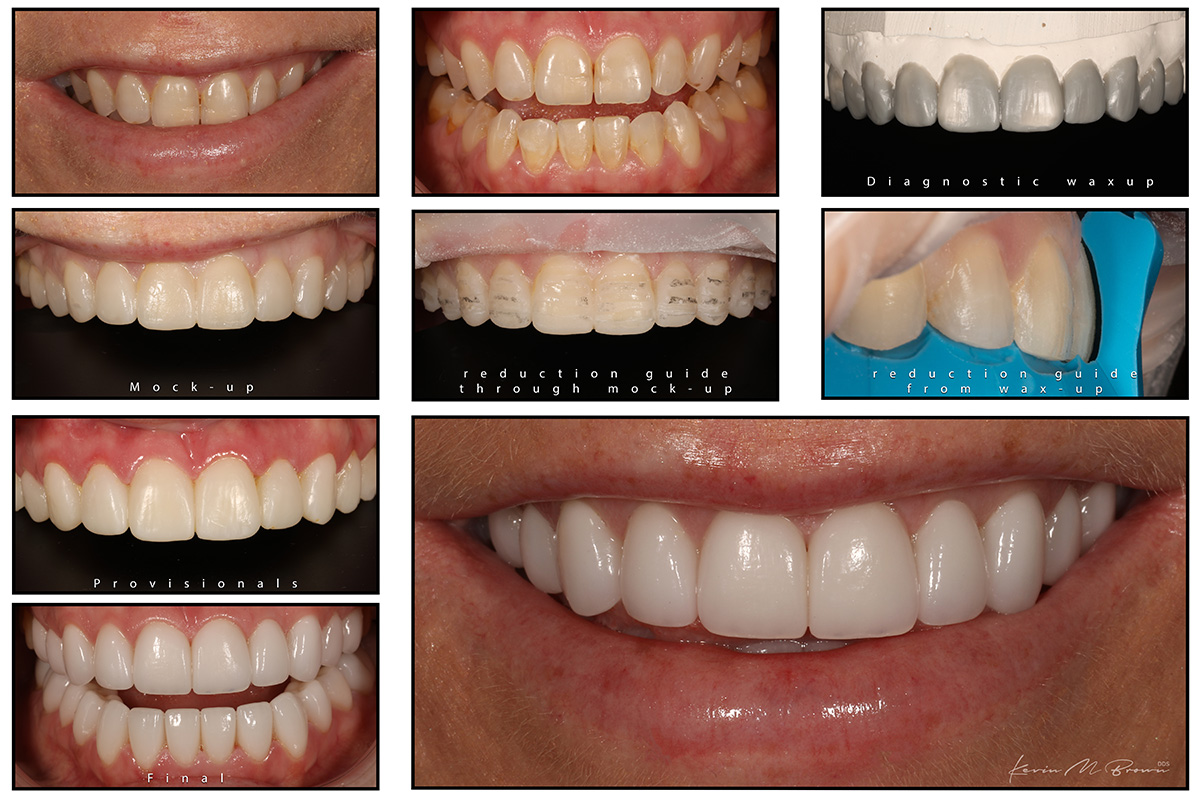 Porcelain Veneers Smile Gallery Cosmetic Dentists In Bellevue Wa