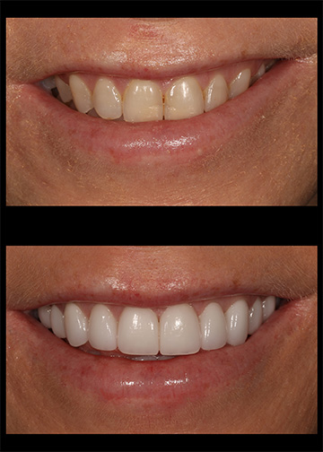 Porcelain Veneers Smile Gallery Cosmetic Dentists In Bellevue Washington
