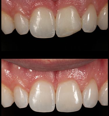 Chipped Teeth Dentist Near Me