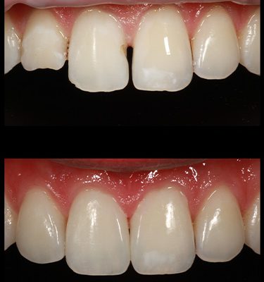 Diastemas Dentsit Near Me