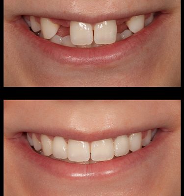 Missing Teeth Or Maryland Bridge Dentist Near You